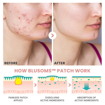 Blusoms™ AcneAtelier Microneedles Patch